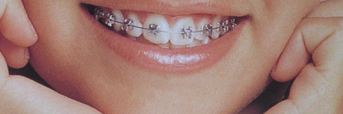 Çocuklarda görülen 'çarpık diş' sorununa dikkat