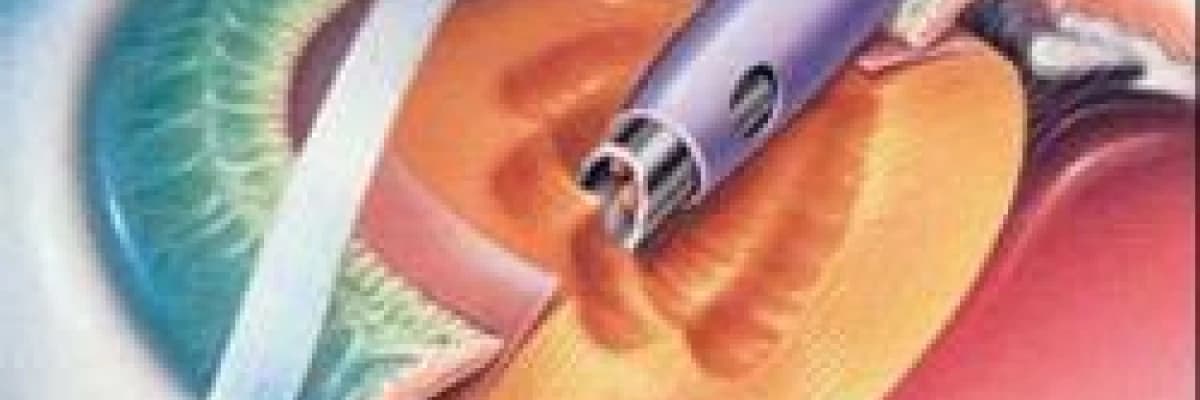 Katarakt ameliyatı (fako)