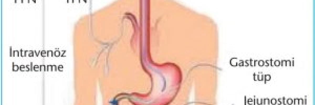 Perkütan endoskopik gastrostomi