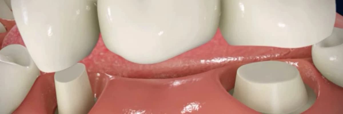 Köprü restorasyonları