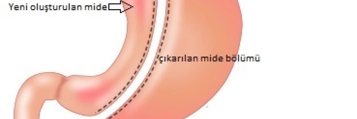 DİYABETE AMELİYATLI TEDAVİ…