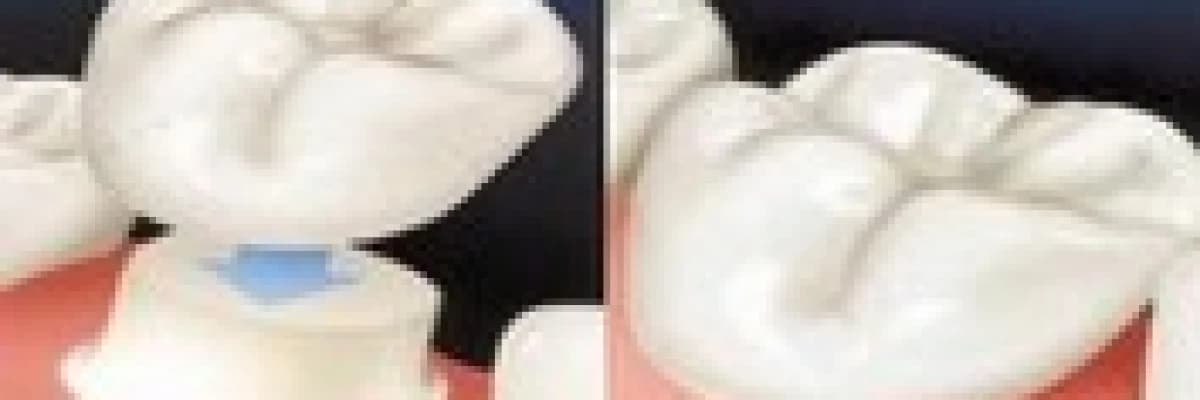 Protez Çeşitleri Tedavisi Hakkında Bilgiler