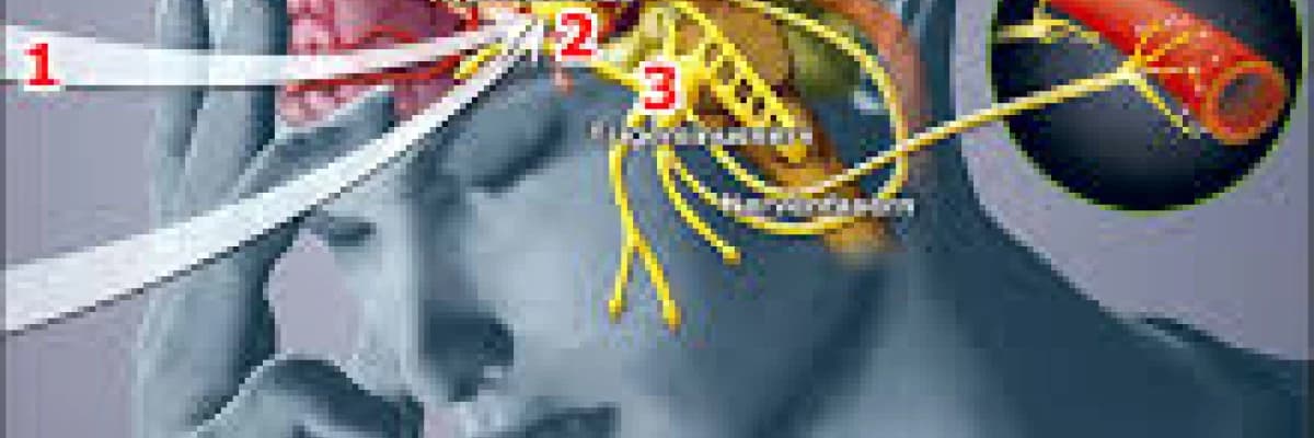 Trigeminal Nevralji nedir?