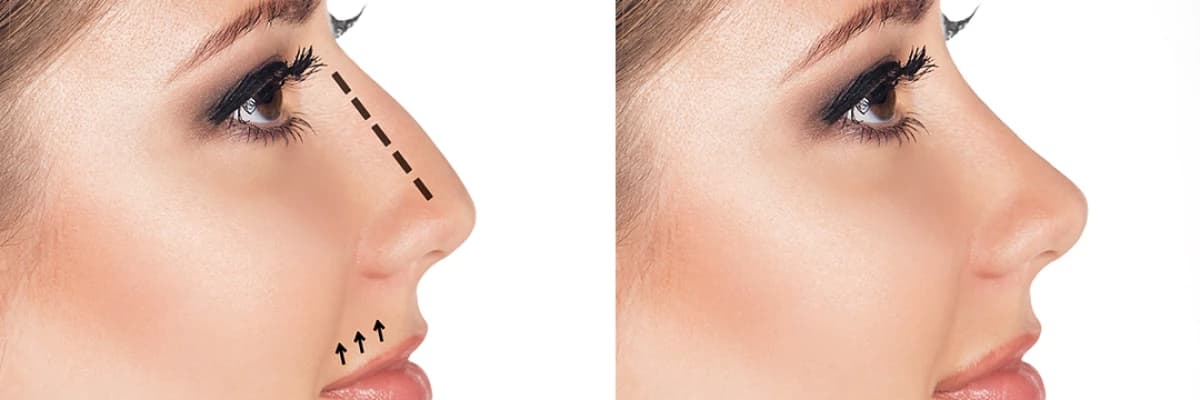 Rinoplasti (Estetik Burun Ameliyatı)