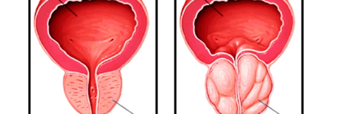 İYİ HUYLU PROSTAT BÜYÜMESİ (BPH)