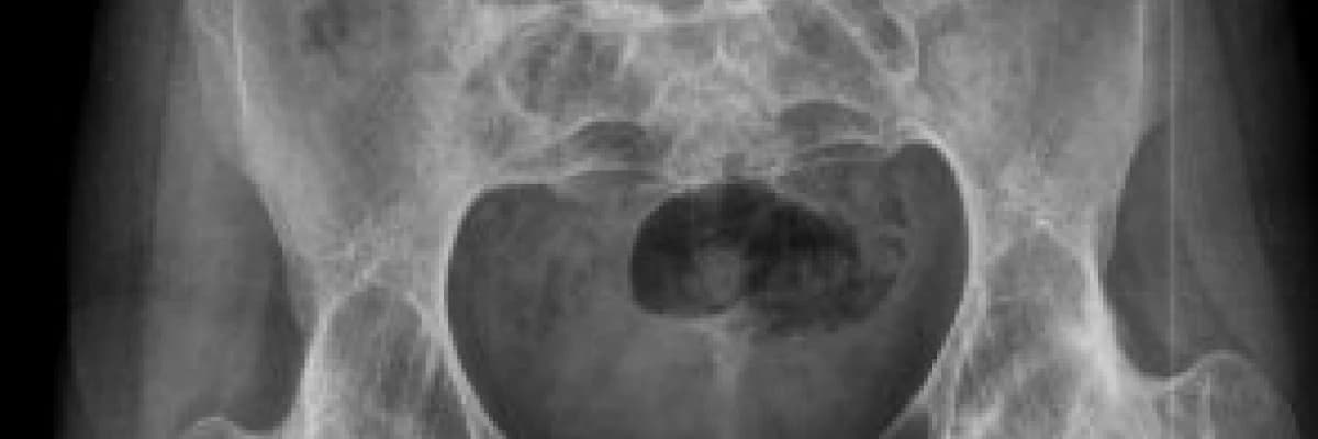 ANKİLOZAN SPONDİLİT (AS) HASTALARI İÇİN YAŞAM İPUÇLARI