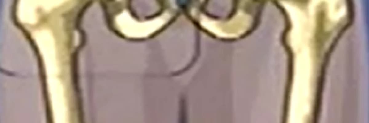 KALÇA ARTROPLASTİSİ