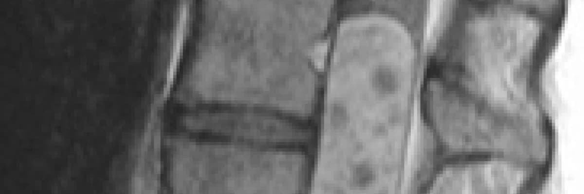 Omurilik Tümörleri Hakkında