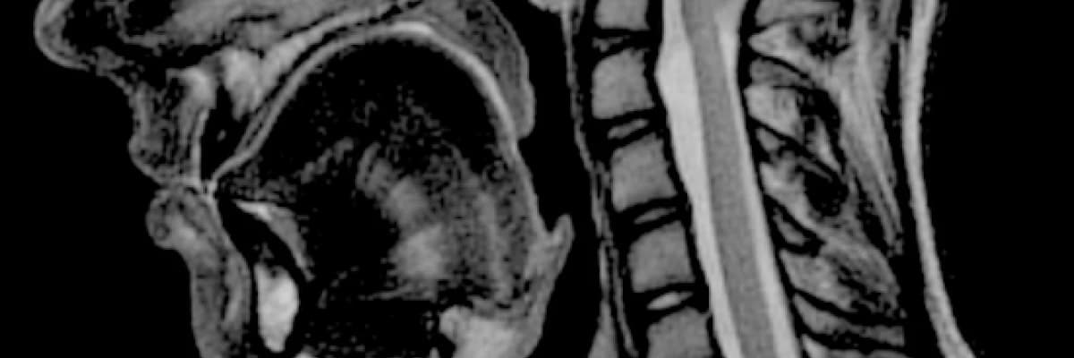 Beyincik sarkması (chiari malformasyonu)