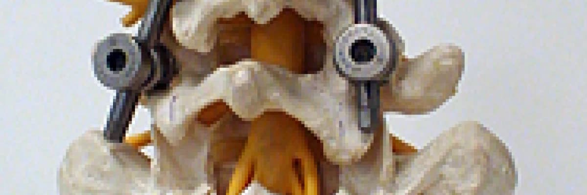 OMURGA PLATİNLEME (VİDA ROD UYGULAMA ) AMELİYATI