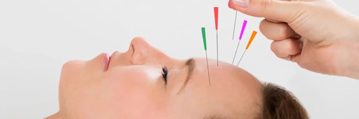 Migren tedavisinde akupunkturun yeri