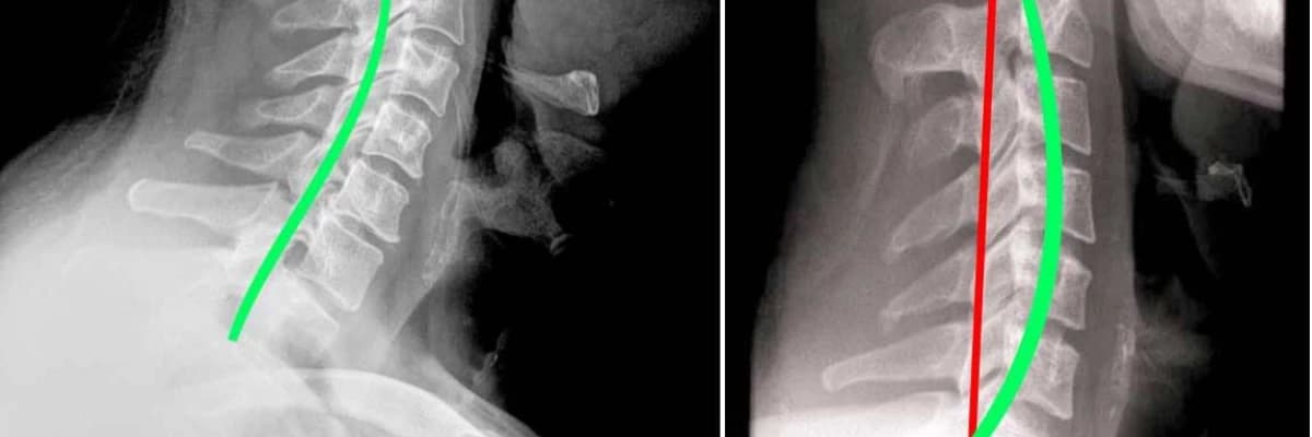 Boyun Düzleşmesi Hastalığı