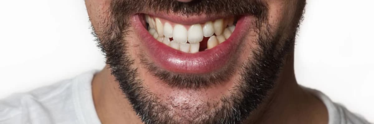 Diş eksikliğinin sağlığınız üzerinde etkisi