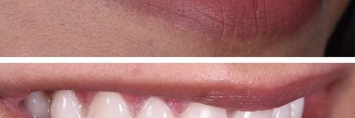 LAMİNA DİŞ NEDİR? LAMİNA DİŞ KİMLERE UYGULANIR?