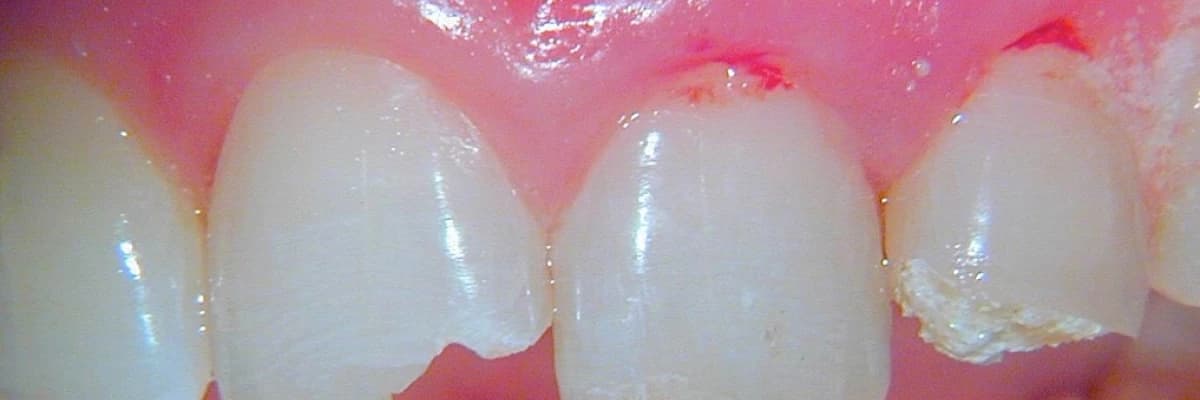 Çocuklarda Diş Travmaları