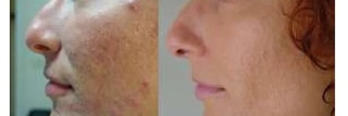 Fraksiyonel Lazer Tedavisi Hakkında