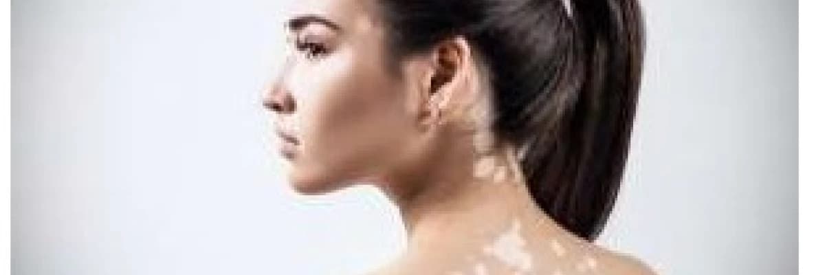 Cilt renginin beyazlaşması sonucu ortaya çıkan bir durum: VİTİLİGO!