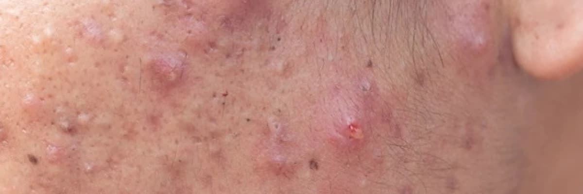 Akne ve sivilce oluşumunu engellemek için neler yapılmalı?