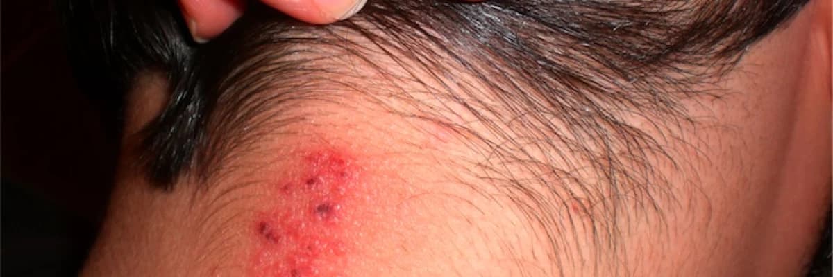 TÜRKİYEDE EN FAZLA RASTLANAN CİLT HASTALIKLARI NELERDİR?