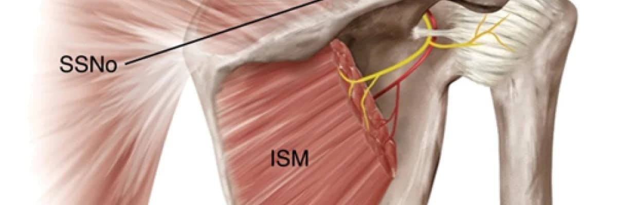 Omuz ağrılarında supraskapular sinir bloğu ve pulsed rf