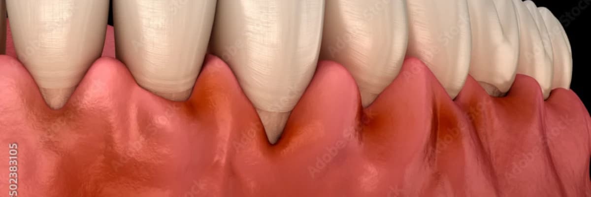 DİŞ ETİ HASTALIKLARI