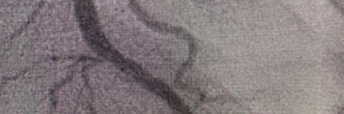 İlaç salınımlı balon nedir?