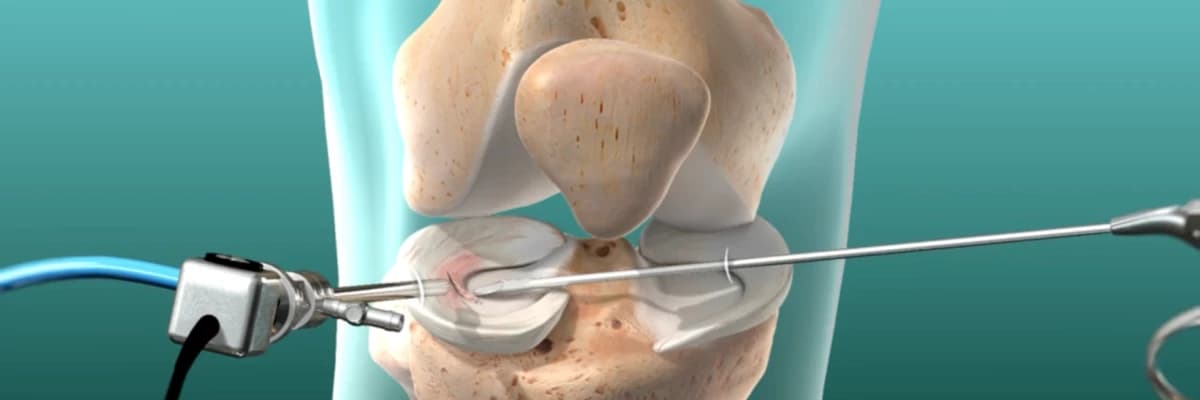 Menisküs Ameliyatı Sonrası Araba Kullanmak