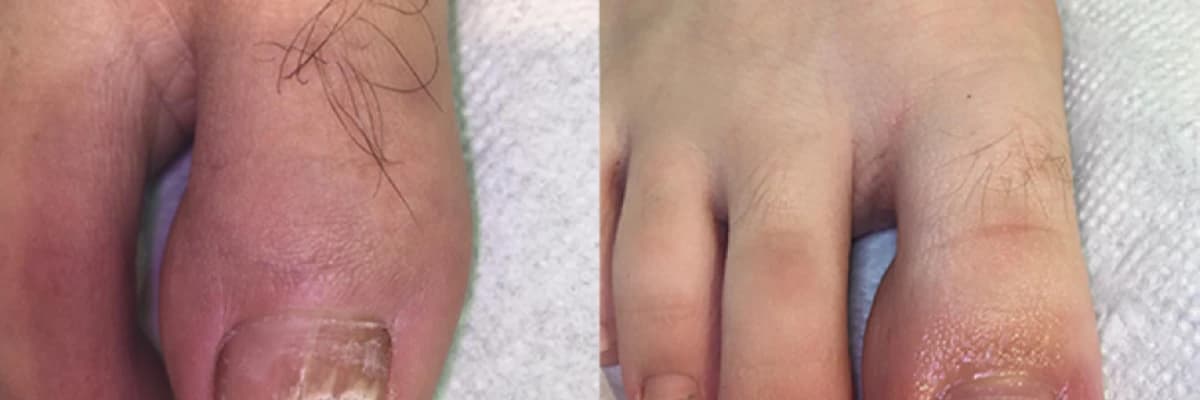 UNGUİS İNCARNATUS NEDİR ? Batık Tırnak