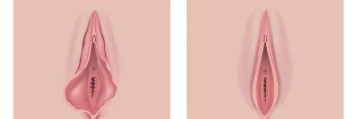 Labioplasti hakkında bilmedikleriniz