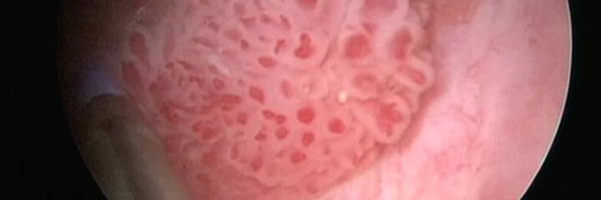 Kasa İnvazif Olmayan Mesane Kanseri