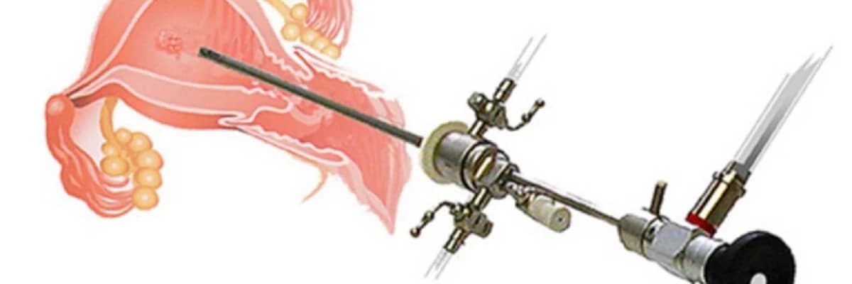 Histeroskopi: Kime? Ne Zaman? - A'dan Z'ye Tüm Detaylar