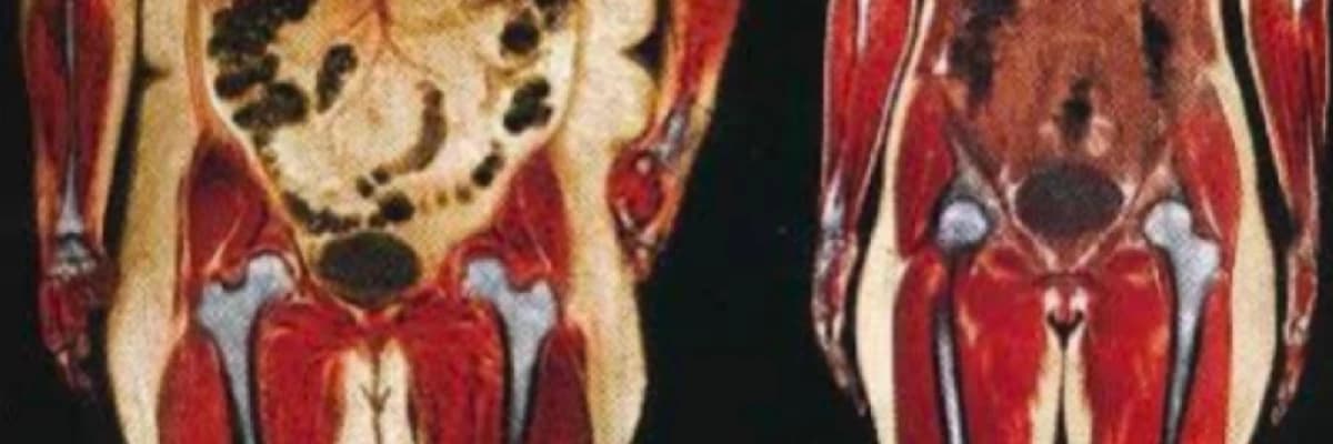 İç Yağlanma: Sağlığınızı Tehdit Eden Görünmeyen Düşman