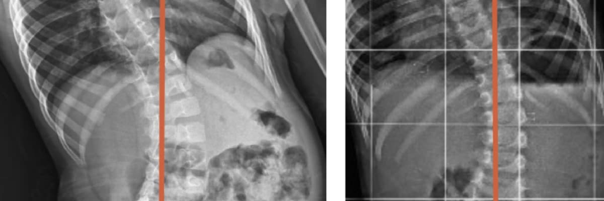 Skolyoterapide İlerleyiş ve Tedavi Yöntemleri