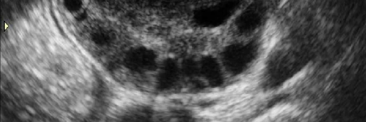 Polikistik Over Sendromu