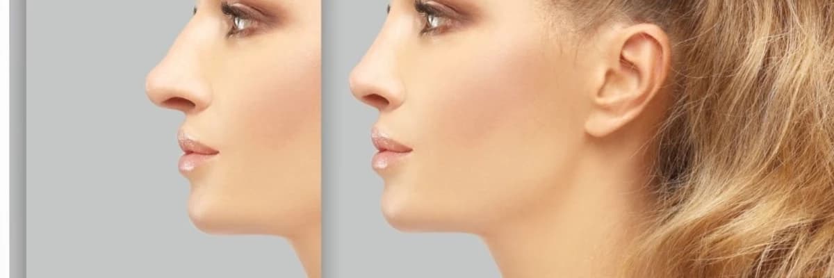 Rinoplasti Ameliyatı Nasıl Yapılır?