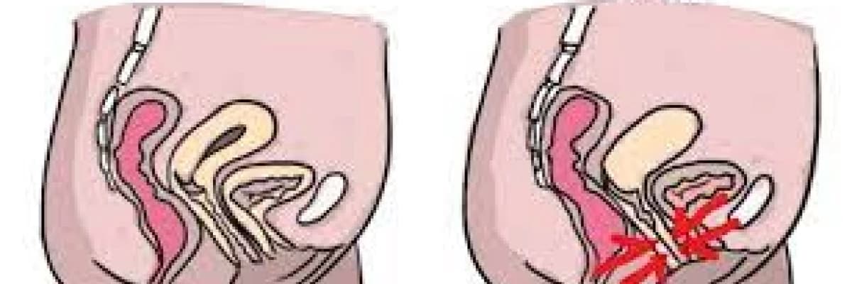 Vajinusmus Belirtileri ve Tedavisi