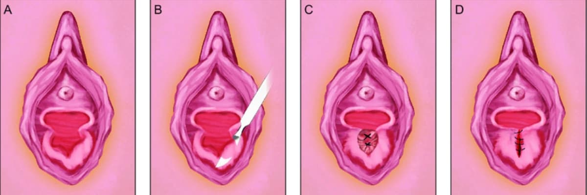 KIZLIK ZARI DİKİMİ