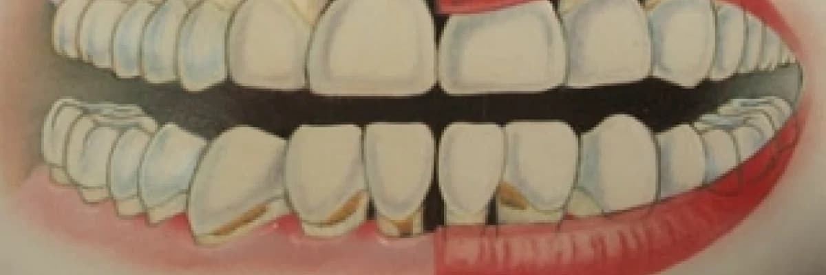 Dişeti iltihabı nasıl oluşur?