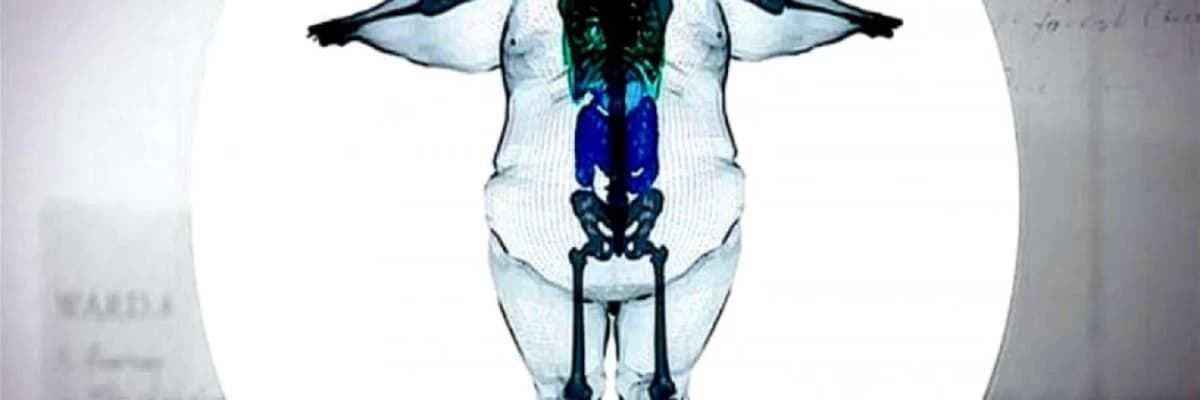 Obezite Çığ Gibi Büyüyor !