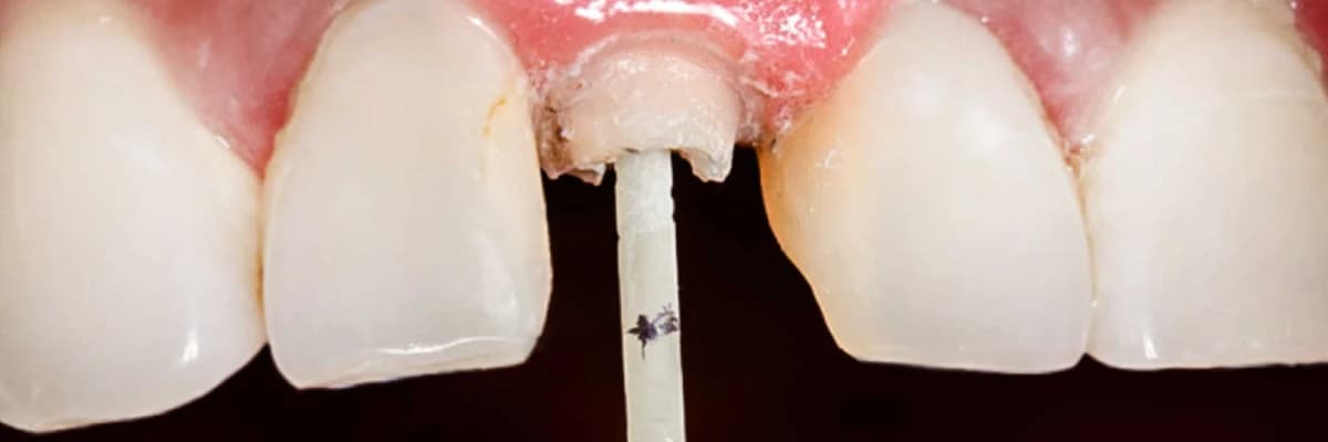 KANAL İÇİ FİBER POST (ÜST KISMI TAMAMEN ÇÜRÜMÜŞ DİŞLERİN KURTARILMASI)