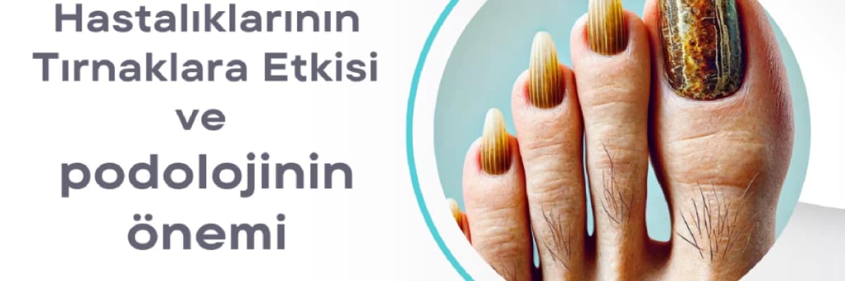 Bağışıklık Sistemi Hastalıklarının Tırnaklarda Oluşturabileceği Sorunlar ve Podolojinin Önemi