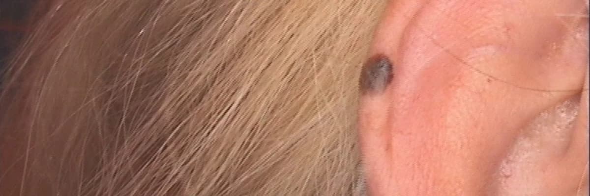 Deri kanseri ve erkek berberleri : Birlikte erken tanıya davet