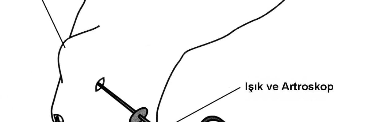El bileği artroskopisi