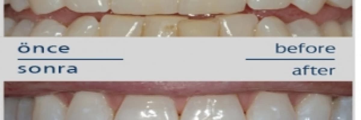 Diş Beyazlatma ( Bleaching ) Nedir ?