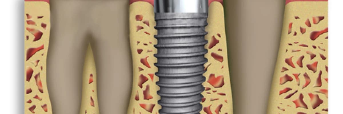 Dental ( Dişle ilgili) İmplantlar