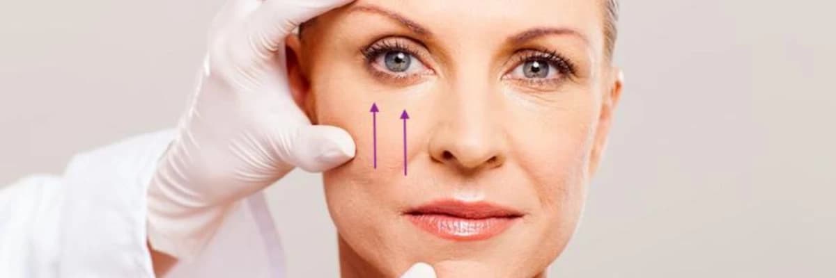 Alt göz kapağı ve orta yüz germe