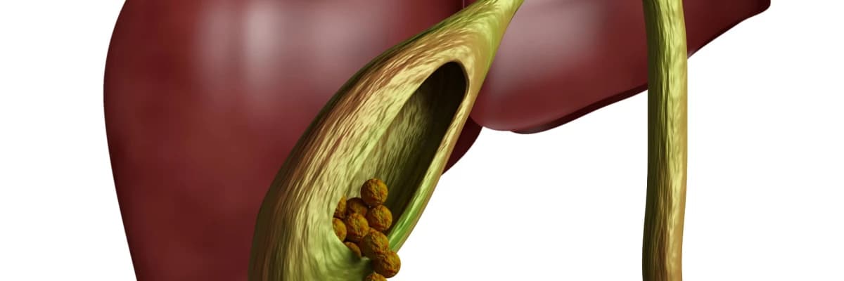 Safra kesesi iltihabı(Kolesistit)