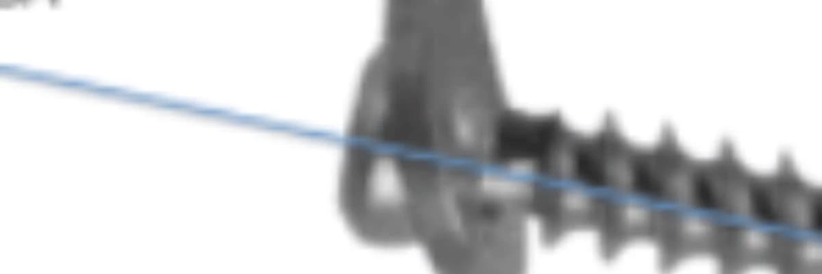 Is there a correlation between the change in the interscrew angle of the eight-plate and the delta joint orientation angles?