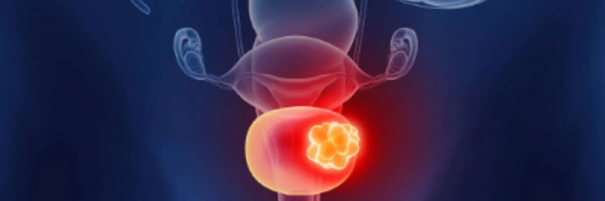 Mesane Kanseri Tedavisi