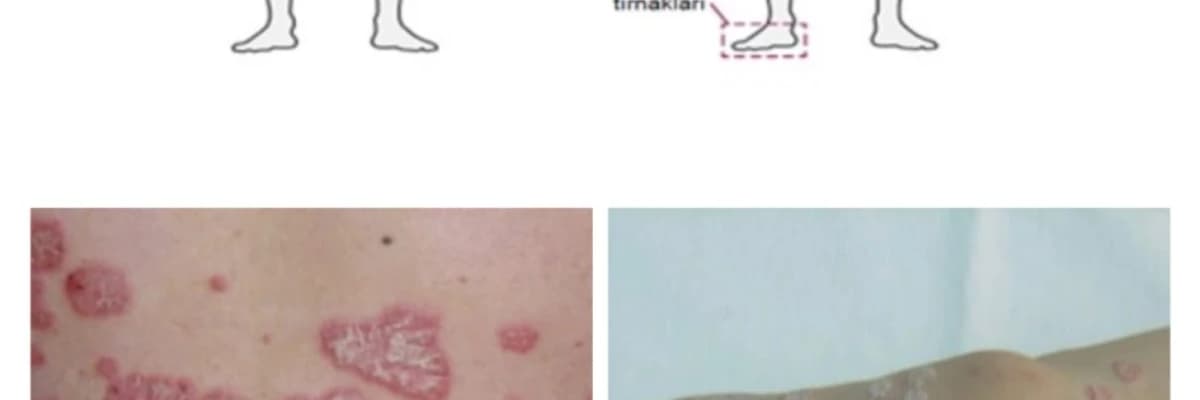 PSÖRİAZİS YANİ SEDEF HASTALIĞI